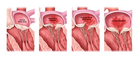 mr mitral valve regurgitation